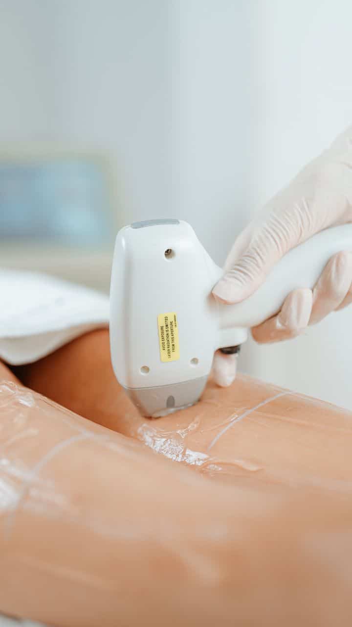 Candela Laser ND:YAG 1064nm - laser nd yag treatment 1