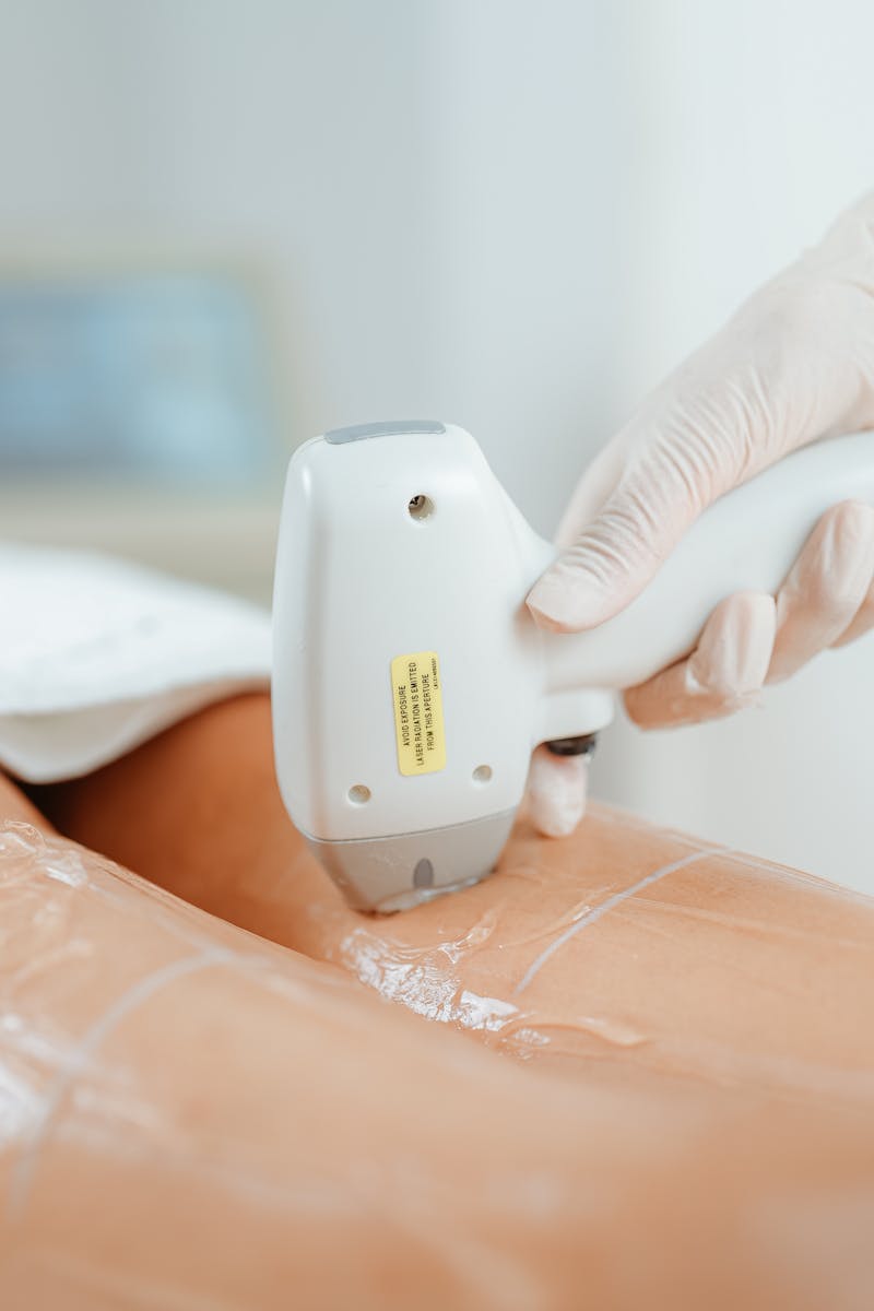 Candela Laser Alexandrite 755nm - pexels laser